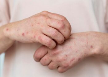 Komisi D DPRD Pati Bakal Koordinasi dengan Dinsos dan Dinkes Soal Kasus Campak