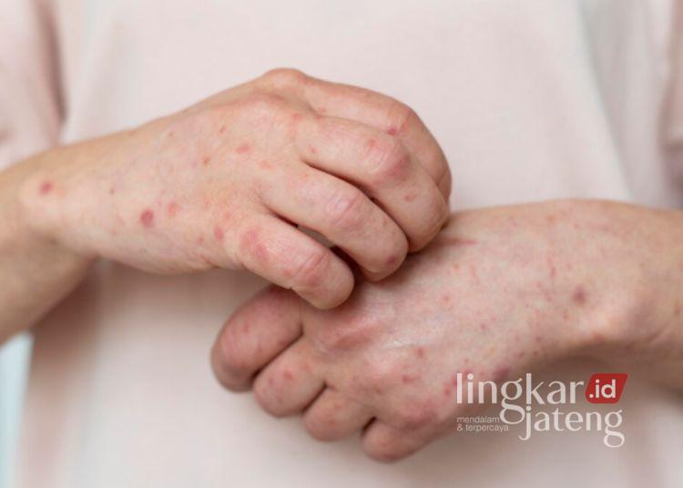 Komisi D DPRD Pati Bakal Koordinasi dengan Dinsos dan Dinkes Soal Kasus Campak 25 Ilustrasi campak. (Freepik)